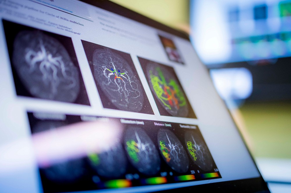 L'&eacute;quipe de recherche utilisera l'imagerie par r&eacute;sonance magn&eacute;tique pour &eacute;tudier l'effet de l'hormonoth&eacute;rapie sur le brouillard cognitif que vivent beaucoup de femmes &agrave; la m&eacute;nopause.