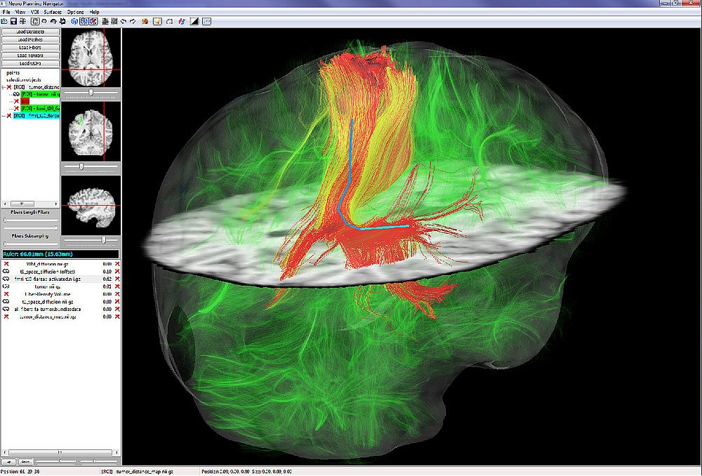 Un aspect du logiciel NeuroPlanning Navigator : on y voit une tumeur, des fibres neuronales en transparence et des outils de mesure.