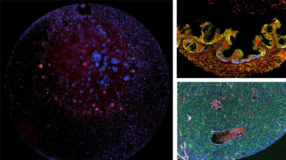 1er Prix (&agrave; gauche) pour l'image &laquo; Le cancer est dans la lune &raquo; de Zacharie Drouin, 2e Prix (en haut &agrave; droite) pour l'image &laquo; Flammes Fatales &raquo; de Zo&eacute; Gerber et 3e Prix (en bas &agrave; droite) pour l'image &laquo; Le cri du cancer de l&rsquo;ovaire &raquo; de Violaine Pourcel. Ces artistes r&eacute;alisent leurs &eacute;tudes dans le laboratoire de Marilyne Labrie, professeure-chercheuse &agrave; l'IRCUS au D&eacute;partement d'immunologie et de biologie cellulaire de la Facult&eacute; de m&eacute;decine et des sciences de la sant&eacute;.