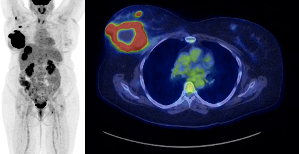 UdeS imaging tech detects breast cancer metastases, per Radio-Canada