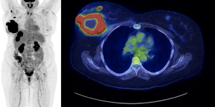 Cancer du sein : deux équipes de l’IRCUS obtiennent 1,05 M$ en subventions pour améliorer les soins