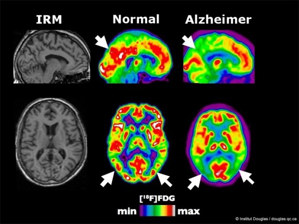 Images de la structure (IRM) et de l&rsquo;activit&eacute; (TEP) du cerveau. La maladie d&rsquo;Alzheimer est associ&eacute;e &agrave; une diminution de la consommation de sucre (FDG) dans des r&eacute;gions pr&eacute;cises indiqu&eacute;es par les fl&egrave;ches.