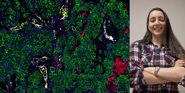 3e&nbsp;Prix :&nbsp;&laquo;&nbsp;Clich&eacute; d'immunofluorescence d'un tissu de m&eacute;tastase c&eacute;r&eacute;brale issu d'un cancer ovarien&nbsp;&raquo;, Korina Mouzakitis, &eacute;tudiante &agrave; la ma&icirc;trise dans le laboratoire de Marilyne Labrie, professeure-chercheuse &agrave; l'IRCUS au d&eacute;partement d'immunologie et de biologie cellulaire de la Facult&eacute; de m&eacute;decine et des sciences de la sant&eacute;