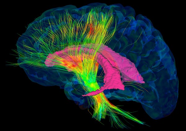L&rsquo;alliance entre l&rsquo;informatique et l&rsquo;imagerie m&eacute;dicale permet une meilleure pr&eacute;cision lors des chirurgies au cerveau.