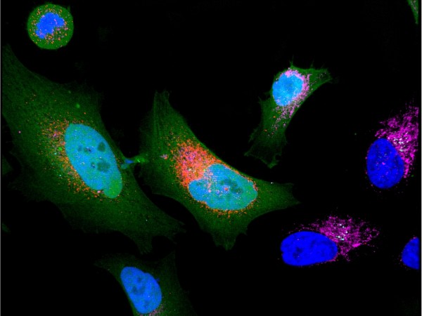 Cancer cell expressing microprotein (colored in red)