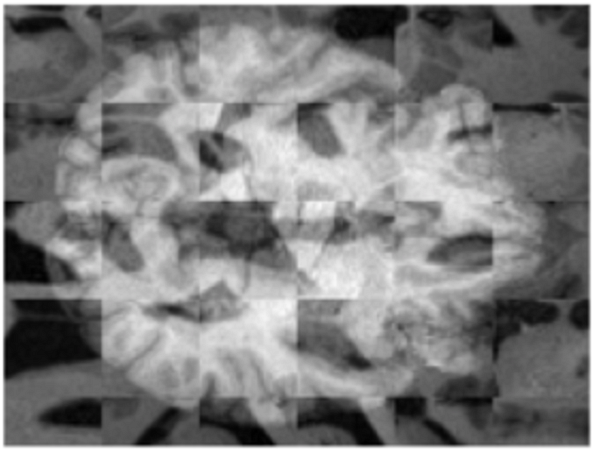 Image corrompue d'un cerveau